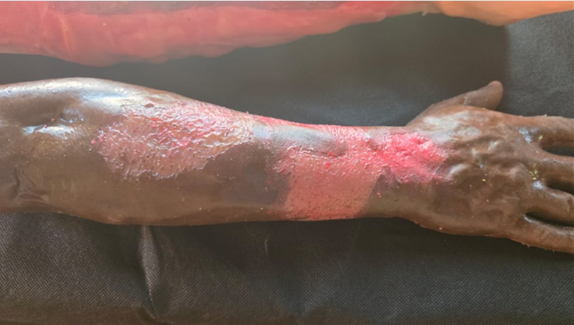 Simulador de Queimadura de Pele – Csanmek Technology